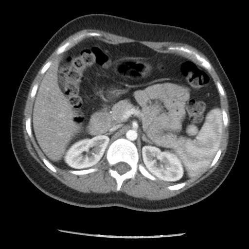 File:Borderline mucinous tumor (ovary) (Radiopaedia 78228-90808 A 50).jpg