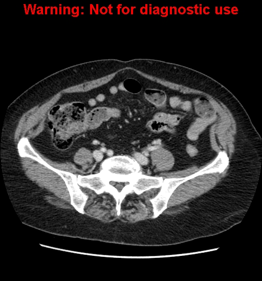 File:Bosniak renal cyst - type II (Radiopaedia 23404-23468 D 50).jpg
