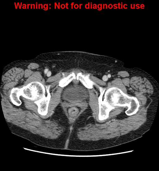File:Bosniak renal cyst - type II (Radiopaedia 23404-23468 D 73).jpg
