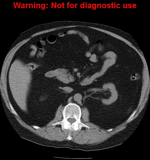 File:Bosniak renal cyst - type IV (Radiopaedia 23402-23466 Axial non-contrast 10).jpg