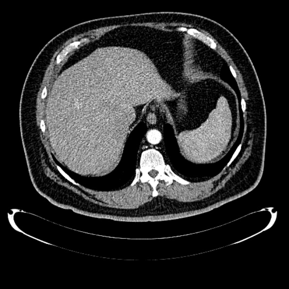 Bosniak renal cyst - type IV (Radiopaedia 24244-24518 B 41).jpg