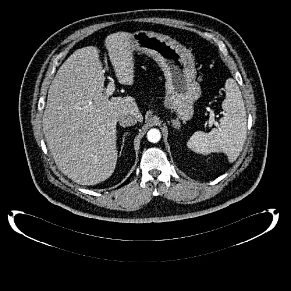Bosniak renal cyst - type IV (Radiopaedia 24244-24518 B 71).jpg