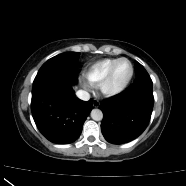 Bosniak renal cyst - type I (Radiopaedia 27479-27675 C 3).jpg