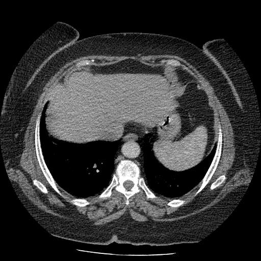 Bovine aortic arch - right internal mammary vein drains into the superior vena cava (Radiopaedia 63296-71875 A 131).jpg
