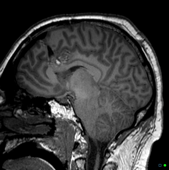 Brain death on MRI and CT angiography (Radiopaedia 42560-45689 Sagittal T1 31).jpg
