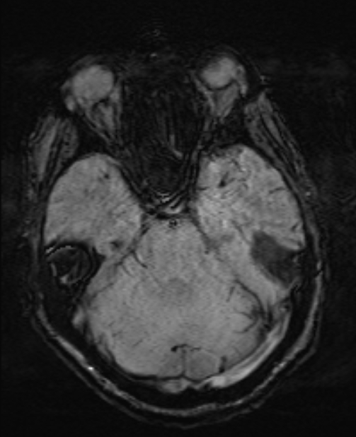 Brain metastases - lung cancer primary (Radiopaedia 75060-86115 Axial SWI 21).jpg