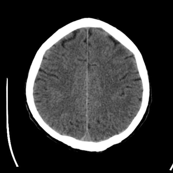Brain metastases from lung cancer (Radiopaedia 24480-24781 Axial non-contrast 36).jpg