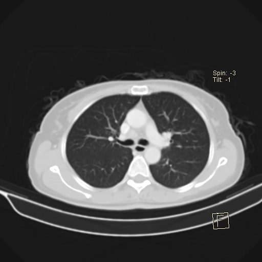 File:Brain metastasis as initial presentation of non-small cell lung cancer (Radiopaedia 65122-74127 Axial lung window 19).jpg