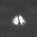 Brainstem glioma (Radiopaedia 67531-76922 Axial DWI 68).jpg