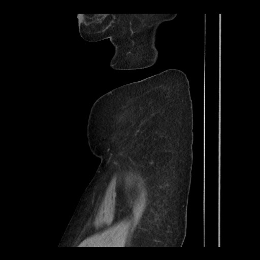 Breast cancer pseudocirrhosis (Radiopaedia 65406-74454 C 33).jpg