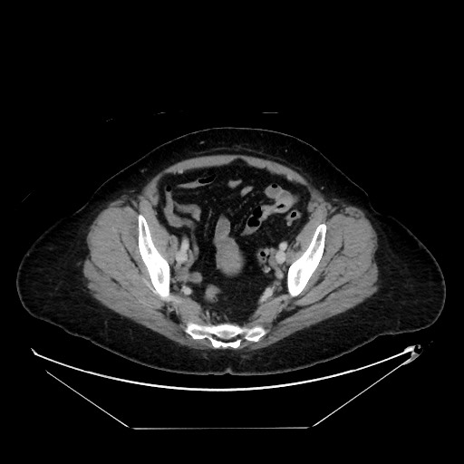 File:Breast cancer pseudocirrhosis with lobar invovlement (Radiopaedia 81080-94670 A 131).jpg
