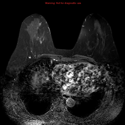 File:Breast carcinoma (multicentric multifocal in mammary Paget disease) (Radiopaedia 50966-56512 Axial T1 C+ fat sat 3).jpg