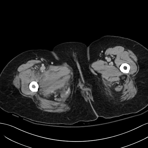 Breast carcinoma with pathological hip fracture (Radiopaedia 60314-67974 B 82).jpg