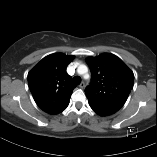 Breast metastases from renal cell cancer (Radiopaedia 79220-92225 A 27).jpg