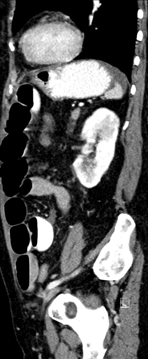 Broad ligament hernia (Radiopaedia 84802-100276 C 20).jpg