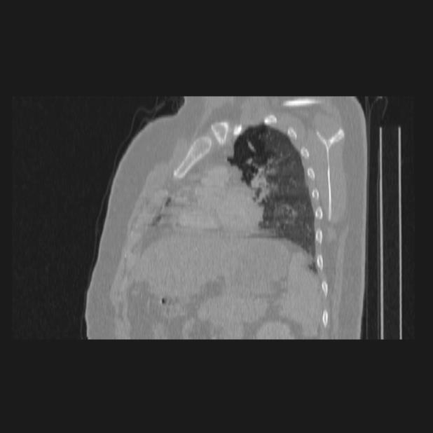 Bronchial atresia (Radiopaedia 60685-68439 Sagittal lung window 61).jpg