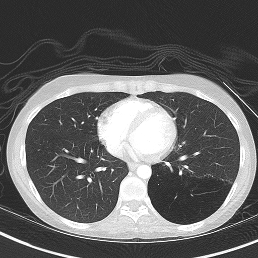 File:Bronchial atresia (Radiopaedia 73677-84470 Axial lung window 40).jpg