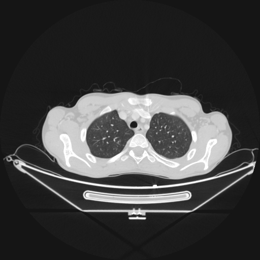 Bronchial carcinoid tumor (Radiopaedia 57187-64090 Axial lung window 12).jpg