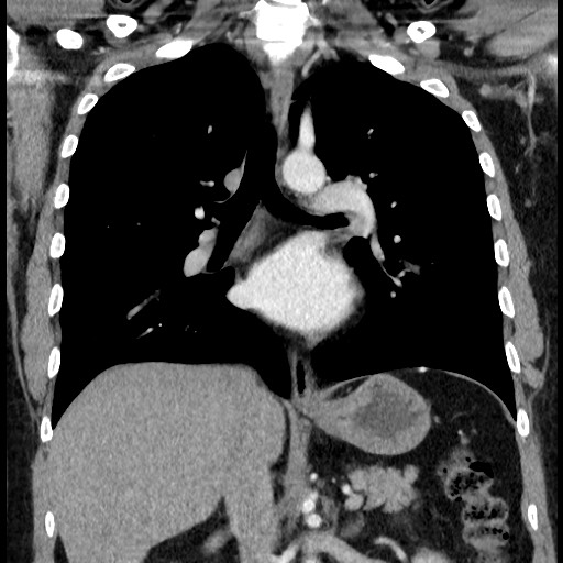 Bronchial carcinoid tumor (Radiopaedia 67377-76764 C 38).jpg