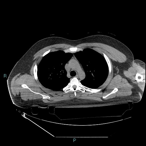 Bronchial carcinoid tumor (Radiopaedia 78272-90870 Axial non-contrast 32).jpg