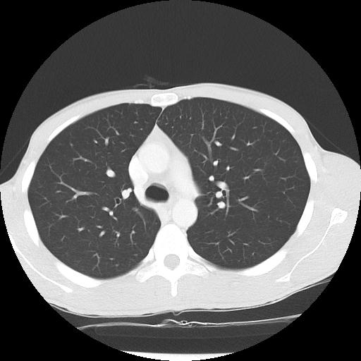 Bronchial carcinoid tumor causing right lower lobe collapse (Radiopaedia 83495-98594 Axial lung window 17).jpg