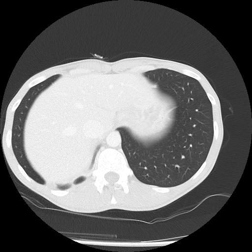 Bronchial carcinoid tumor causing right lower lobe collapse (Radiopaedia 83495-98594 Axial lung window 48).jpg