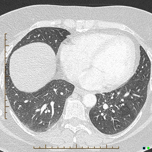 Bronchial diverticula (Radiopaedia 79512-92676 Axial lung window 141).jpg