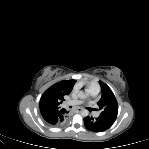 Bronchial mucoepidermoid carcinoma (Radiopaedia 57023-63895 Axial 50).jpg