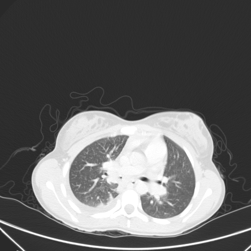 Bronchial mucoepidermoid carcinoma (Radiopaedia 57023-63895 Axial lung window 47).jpg
