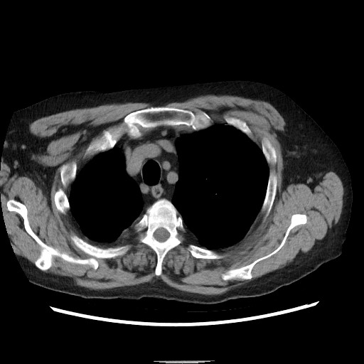Bronchial stenosis - lung transplant (Radiopaedia 73133-83848 Axial non-contrast 13).jpg