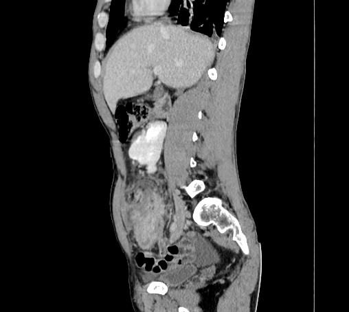 File:Bronchiectasis in Crohn disease (Radiopaedia 60311-67977 D 41).jpg