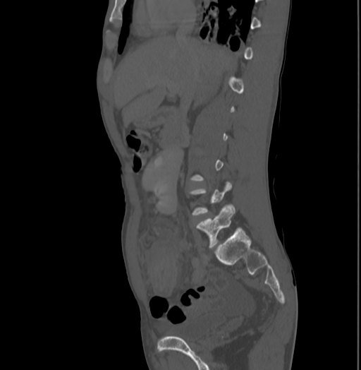 Bronchiectasis in Crohn disease (Radiopaedia 60311-67977 Sagittal bone window 90).jpg