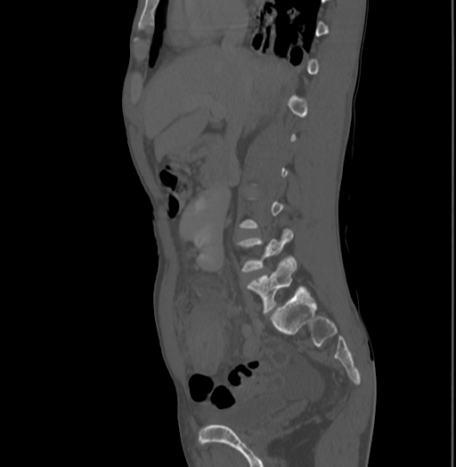 File:Bronchiectasis in Crohn disease (Radiopaedia 60311-67977 Sagittal bone window 91).jpg