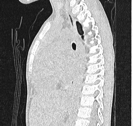 Bronchiolitis obliterans (Radiopaedia 71538-81897 Sagittal lung window 37).jpg