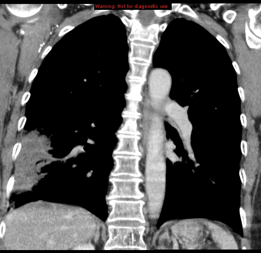 Bronchoalveolar carcinoma (BAC) (Radiopaedia 13436-13392 E 36).jpg