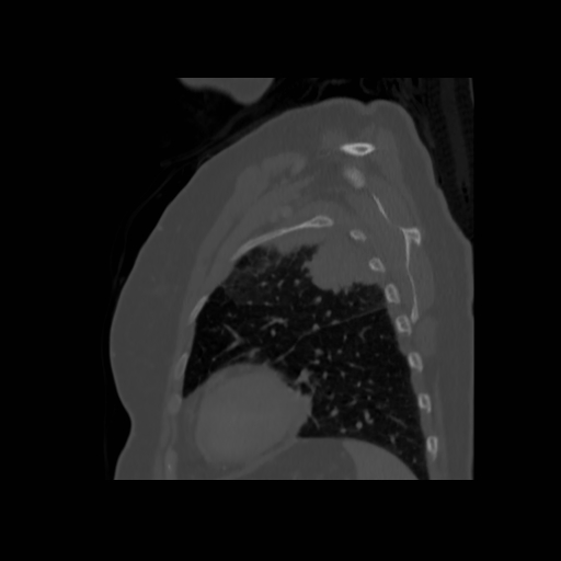 Bronchogenic carcinoma (Radiopaedia 73497-84262 Sagittal bone window 121).jpg