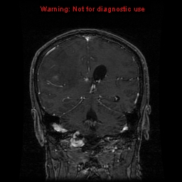 File:Bronchogenic carcinoma brain metastasis (Radiopaedia 9286-9969 Coronal T1 6).jpg