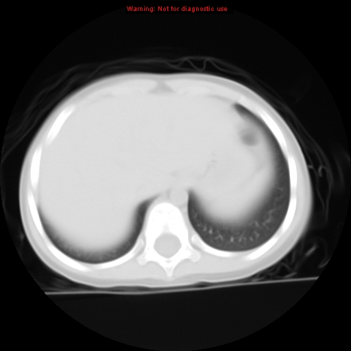 File:Bronchogenic cyst (Radiopaedia 9372-10063 Axial lung window 15).jpg