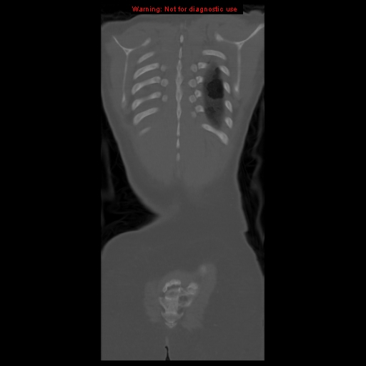 File:Brown tumor (Radiopaedia 12318-12596 D 59).jpg