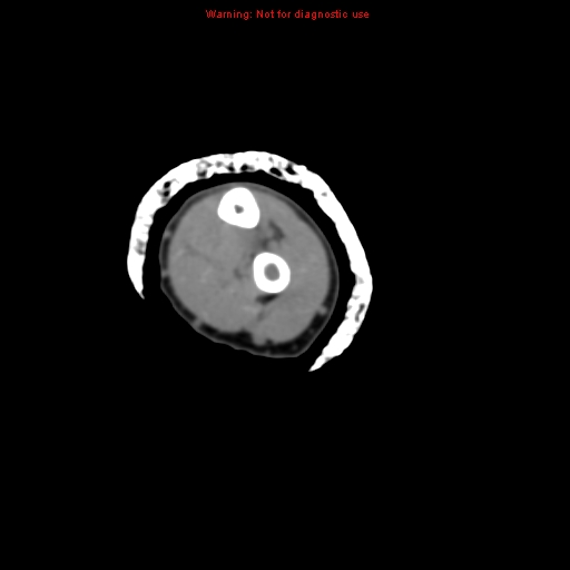 Brown tumor (Radiopaedia 12460-12694 Axial non-contrast 100).jpg