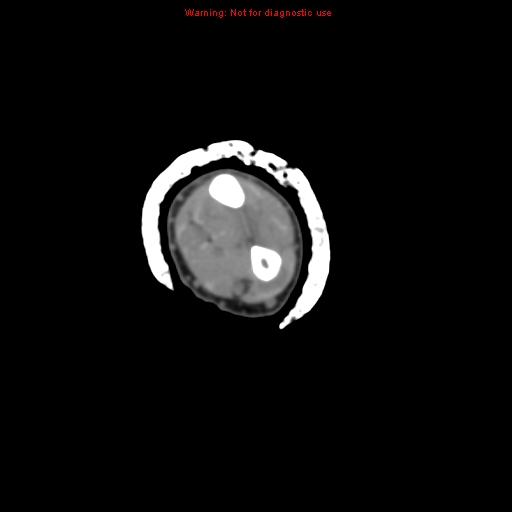 Brown tumor (Radiopaedia 12460-12694 Axial non-contrast 77).jpg