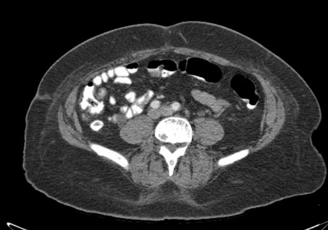 Brown tumors compressing the spinal cord (Radiopaedia 68442-77988 E 78).jpg