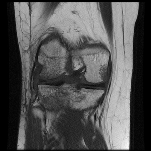 File:Bucket handle meniscus tear (Radiopaedia 56916-63751 Coronal T1 13).jpg