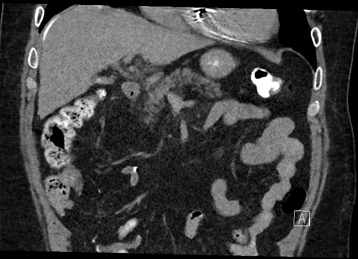 Buried bumper syndrome - gastrostomy tube (Radiopaedia 63843-72577 Coronal Inject 56).jpg