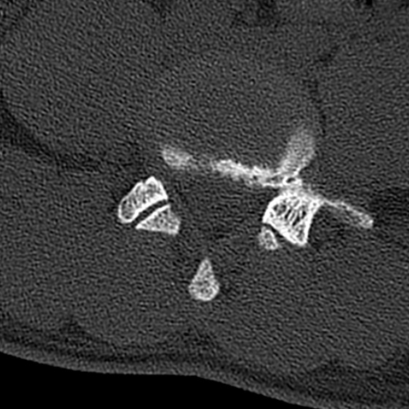 Burst fracture (Radiopaedia 53373-59357 Axial bone window 54).jpg