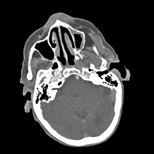 File:C2 fracture with vertebral artery dissection (Radiopaedia 37378-39200 A 211).png