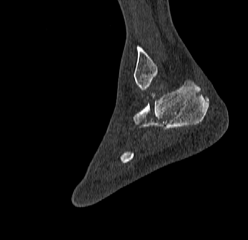 Calcaneal fracture - Sanders type 4 (Radiopaedia 90179-107370 Sagittal bone window 70).jpg