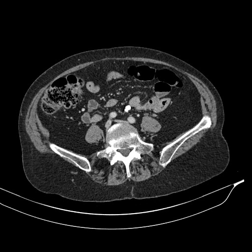 Calcified adrenal glands and Spigelian hernia (Radiopaedia 49741-54988 A 145).jpg
