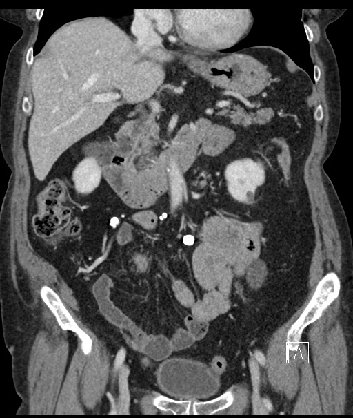Calcified adrenal glands and Spigelian hernia (Radiopaedia 49741-54988 B 49).jpg