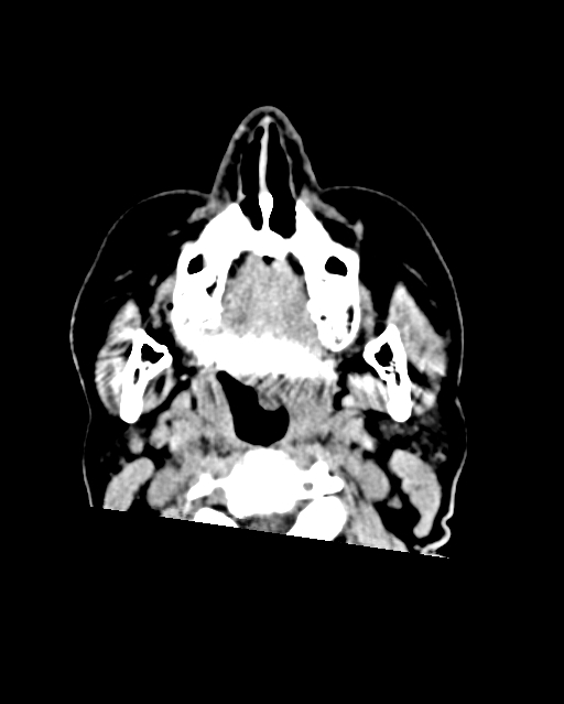 Calcified meningioma (Radiopaedia 74361-85243 Axial non-contrast 63).jpg